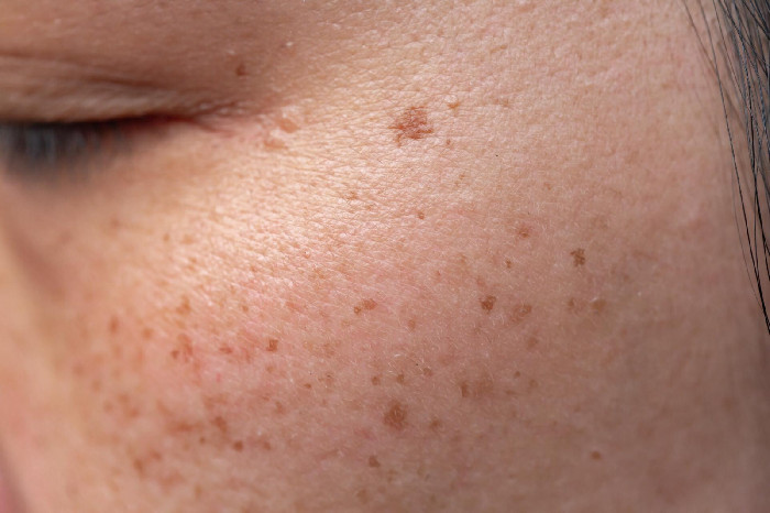 How Aging Affects Your Skin: Spots, Growths, and Texture Changes :: Herbal-care-products